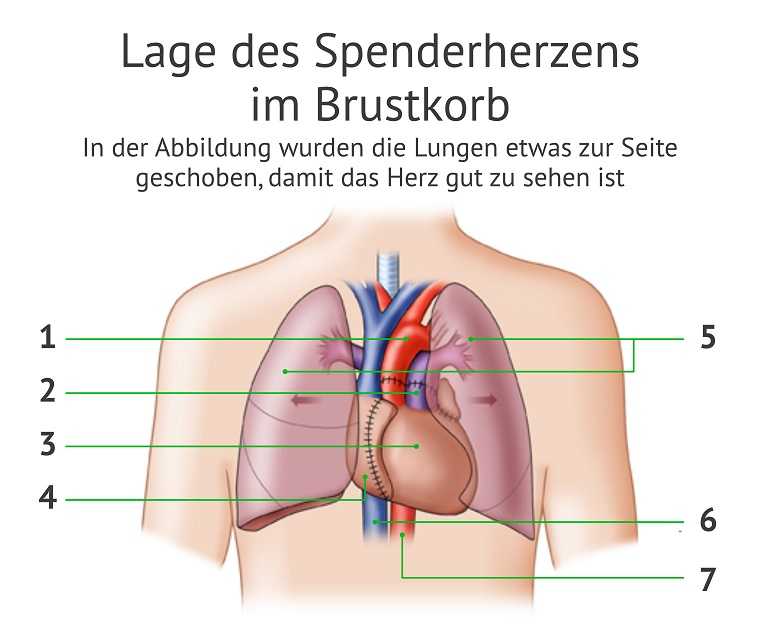 Diese Grafik zeigt die Lage des Spenderherzens im menschlichen Brustkorb
