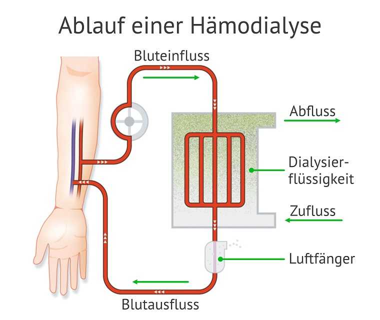 Die Grafik zeigt den Ablauf einer Hämodialyse