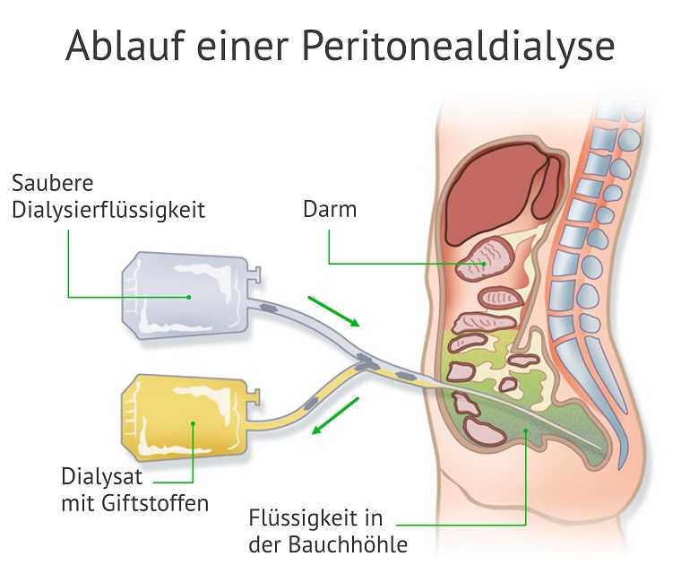 Diese Grafik veranschaulicht den Ablauf der Peritonealdialyse
